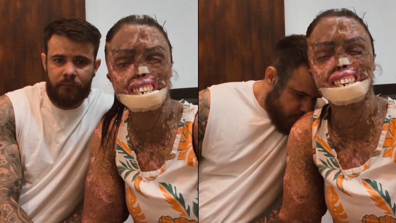 Xeroderma Pigmentoso: entenda a doença rara que exige vida noturna e afeta influenciadora de Fortaleza