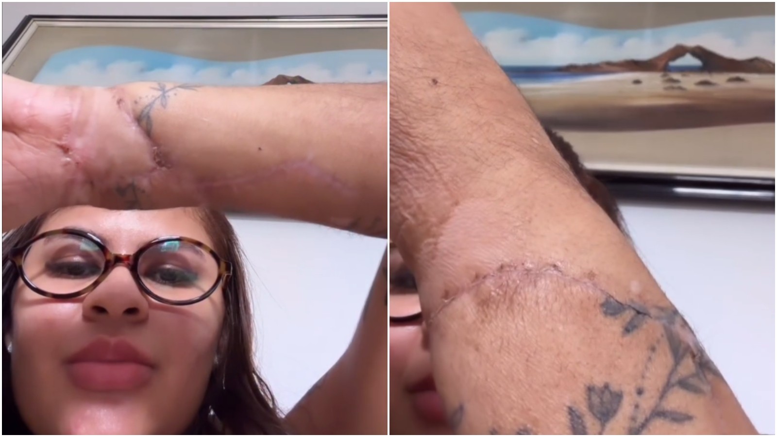 Jovem mostra cicatrizes após reimplante das mãos e revela como sobreviveu a ataque no Ceará